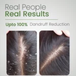 Before and after results showing reduced dandruff after using Aloe Pure Shampoo