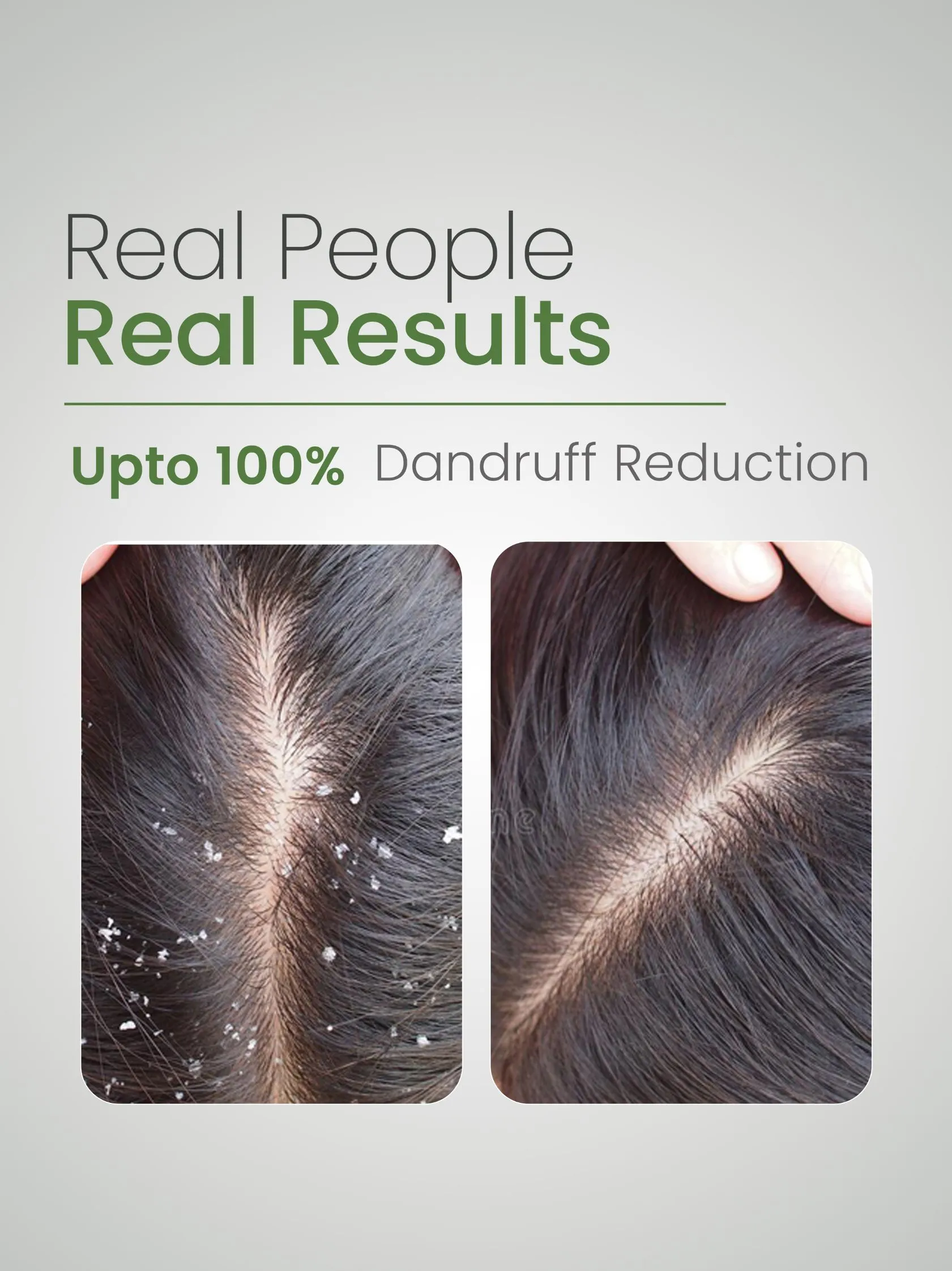 Before and after results showing reduced dandruff after using Aloe Pure Shampoo
